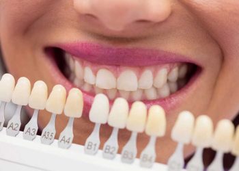 Carillas dentales