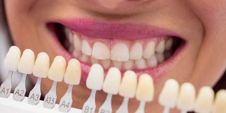 Carillas dentales