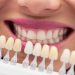 Carillas dentales